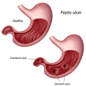 Symptoms of peptic ulcer include burning stomach pain, bloating, nausea, and black stools, often worsening on an empty stomach.